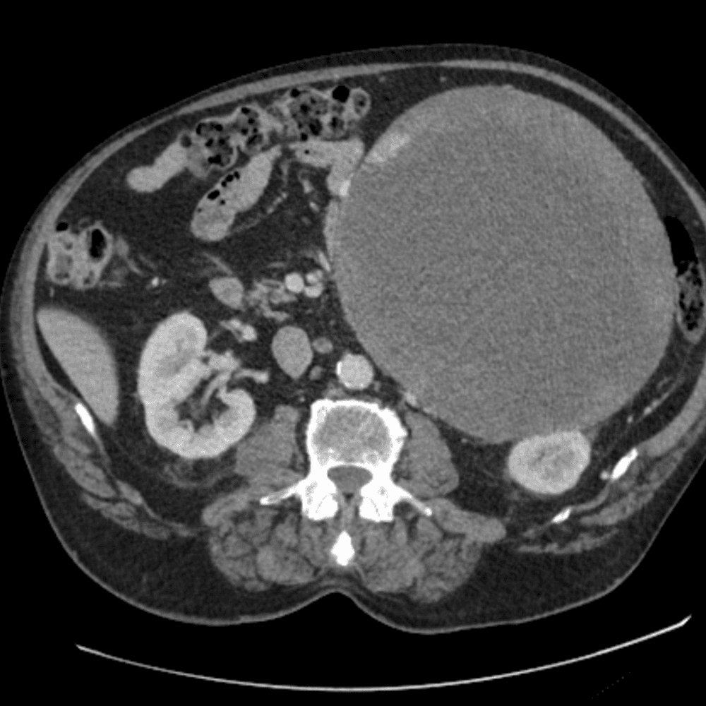 Guza wielkości piłki do koszykówki dla dzieci, ważącego 5 kg usunęli chirurdzy Klinicznego Oddziału Chirurgii Ogólnej i Onkologicznej z brzucha 70-letniego pacjenta.